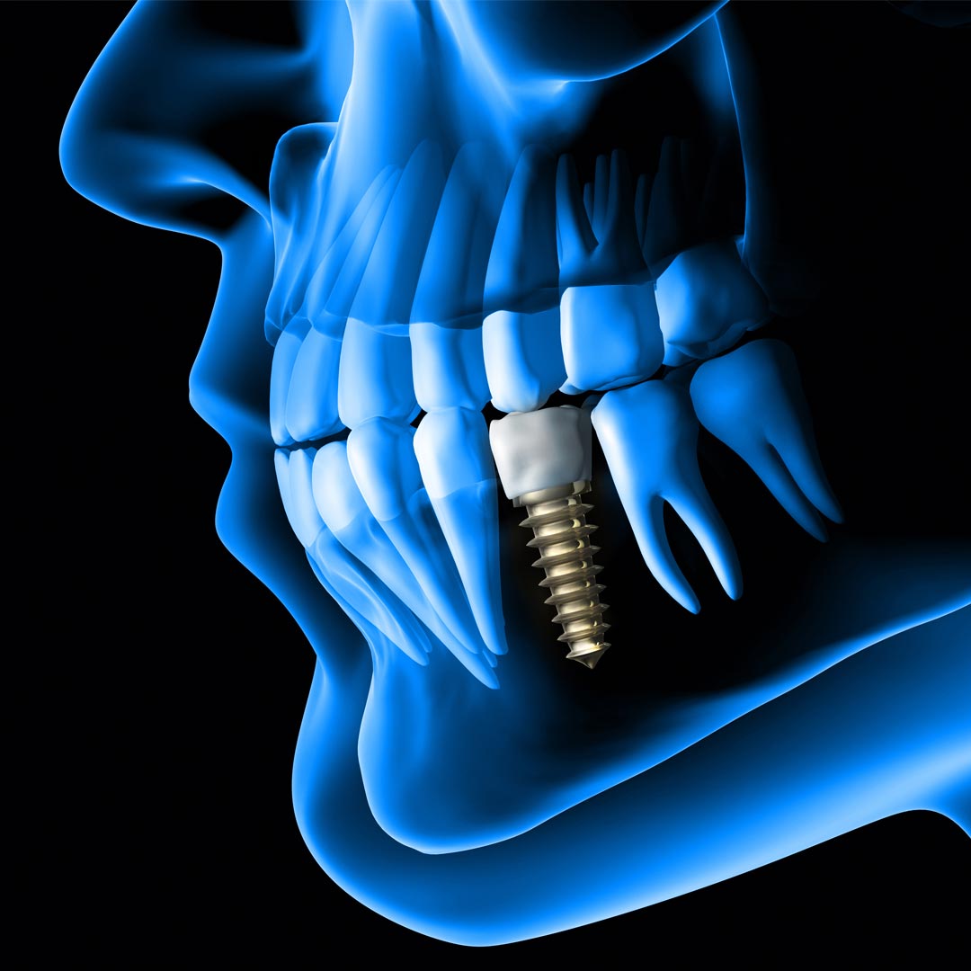 best dental implant clinic in dubai ,